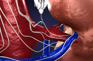 La Hipertensión Arterial Refractaria dejó de ser un problema de salud (Video)