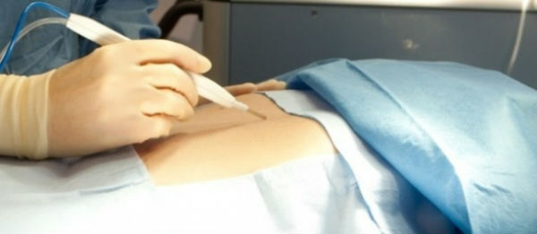 Este bisturí detecta el tejido cancerígeno durante la operación