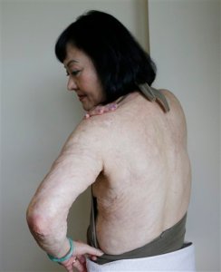 Kim Phuc: “La niña del napalm” se atiende cicatrices con láser