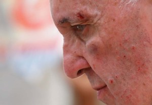 Así quedó el rostro del Papa tras golpearse contra el papamóvil  (fotos)