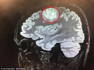 Le extrajeron un tumor cerebral mientras estaba despierto (Fotos)