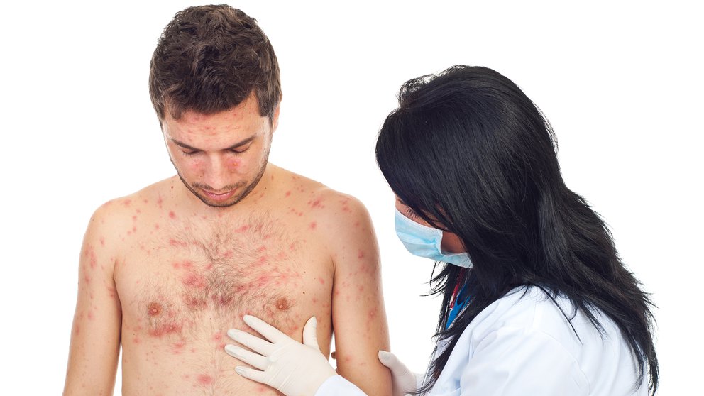 ¿Qué lesiones de la piel se asocian al coronavirus?