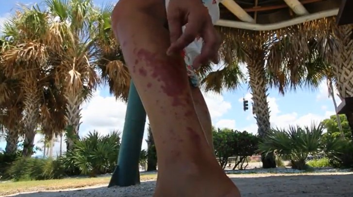 Una mujer se infecta con la bacteria ‘comecarne’ tras nadar en una playa en Florida (Fotos)