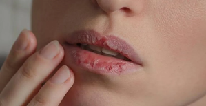 Labios resecos: un síntoma común que puede ser señal de cinco graves enfermedades