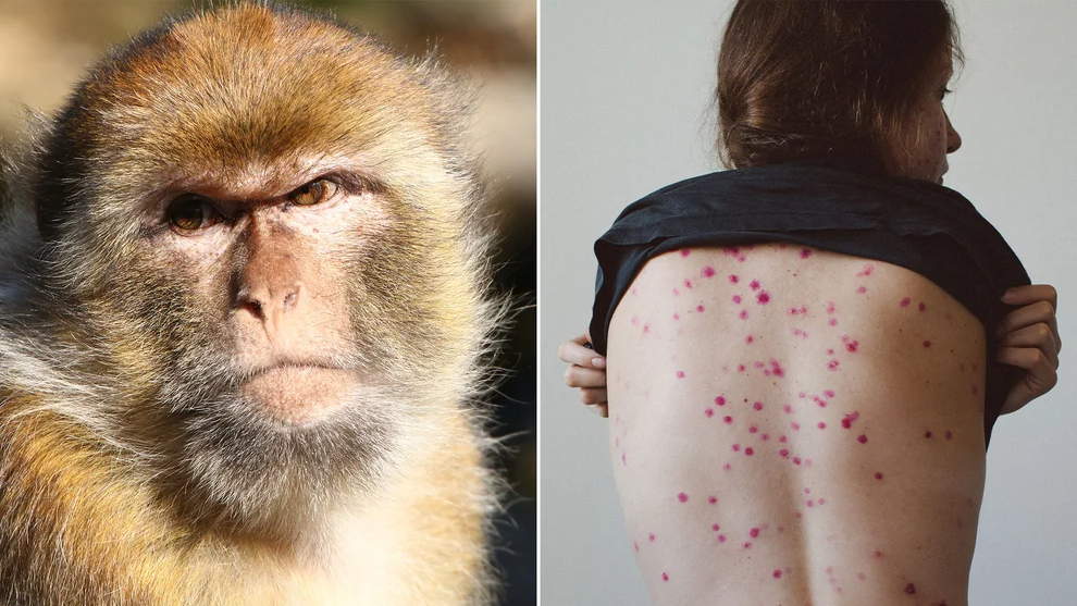 Viruela del mono: mitos y verdades de la enfermedad que tiene al mundo en alerta