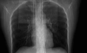 Una mujer tosió tan fuerte que se “rompió” por dentro: el llamativo resultado de la tomografía