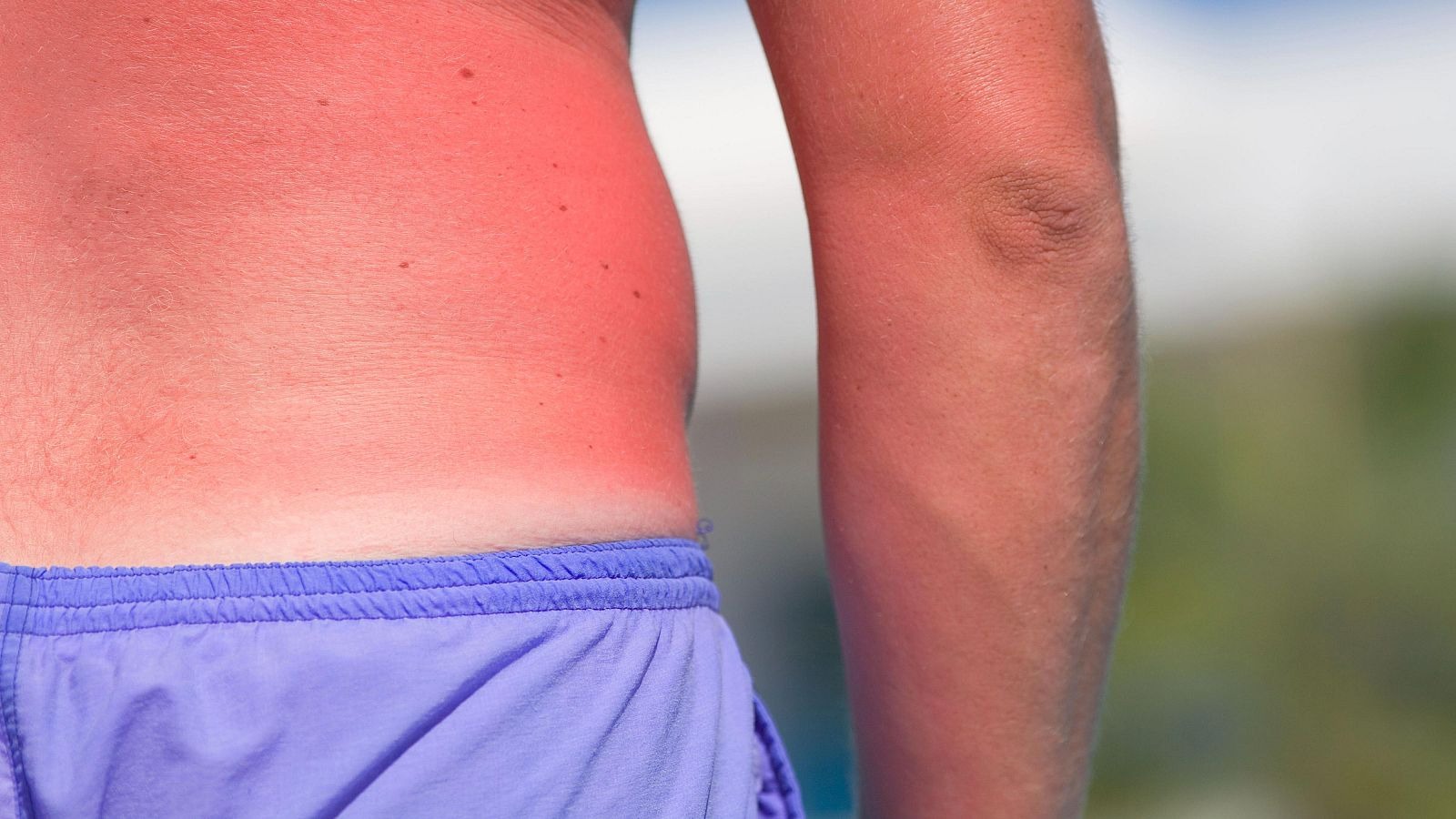 El callo solar, la peligrosa y falsa tendencia viral en TikTok, no existe: “Aumenta el riesgo de un cáncer de piel”